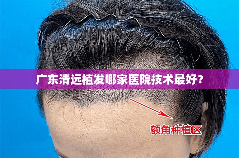 广东清远植发哪家医院技术最好？