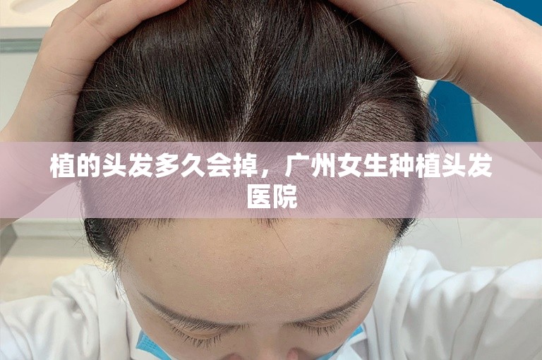 植的头发多久会掉，广州女生种植头发医院