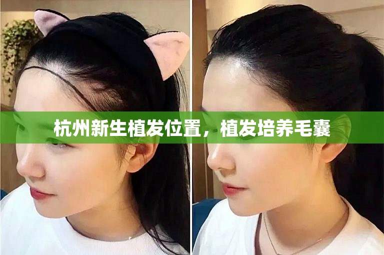 杭州新生植发位置，植发培养毛囊