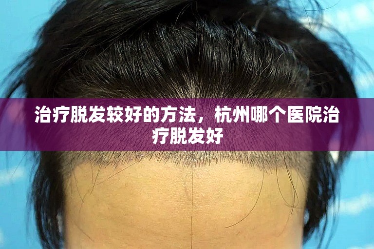 治疗脱发较好的方法，杭州哪个医院治疗脱发好