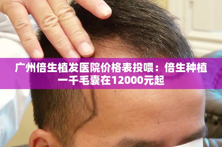 广州倍生植发医院价格表投喂：倍生种植一千毛囊在12000元起