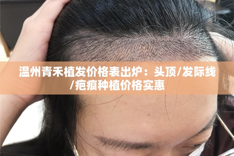 温州青禾植发价格表出炉：头顶/发际线/疤痕种植价格实惠