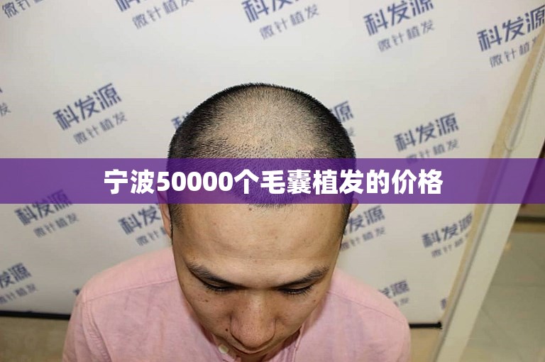 宁波50000个毛囊植发的价格