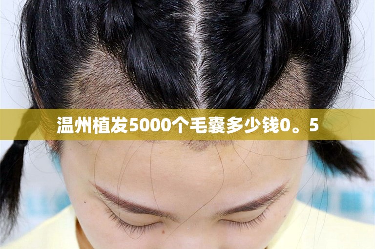 温州植发5000个毛囊多少钱0。5