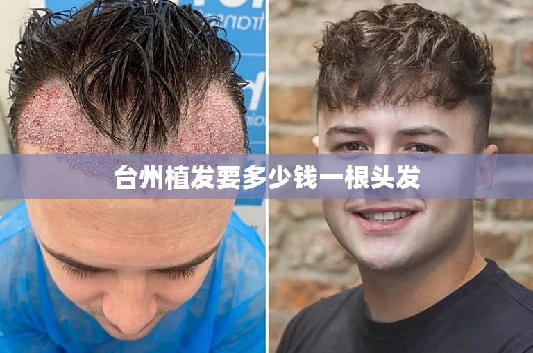 台州植发要多少钱一根头发