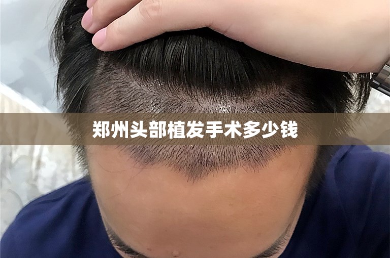 郑州头部植发手术多少钱