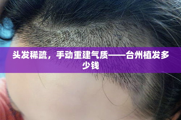 头发稀疏，手动重建气质——台州植发多少钱