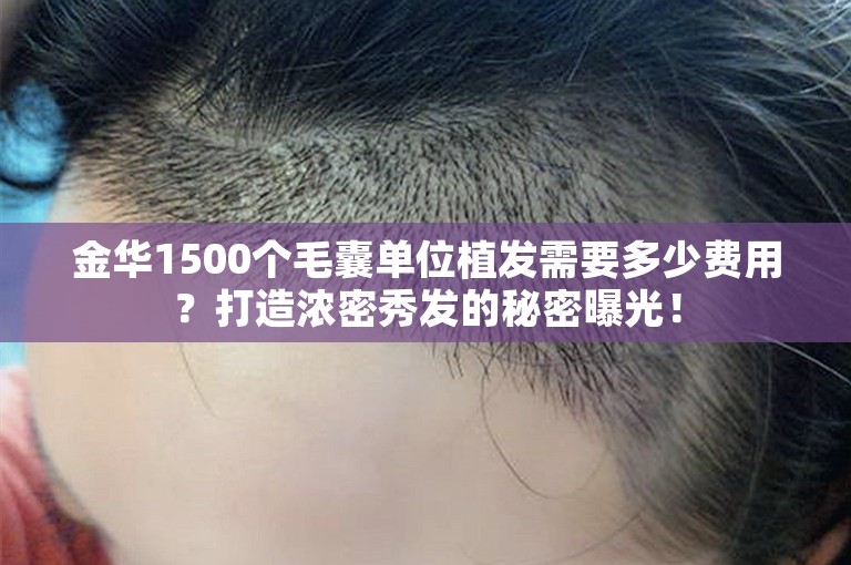 金华1500个毛囊单位植发需要多少费用？打造浓密秀发的秘密曝光！