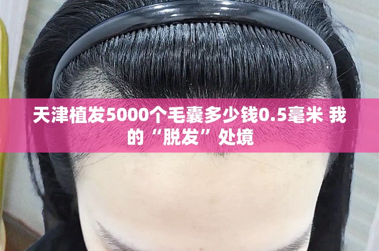 天津植发5000个毛囊多少钱0.5毫米 我的“脱发”处境