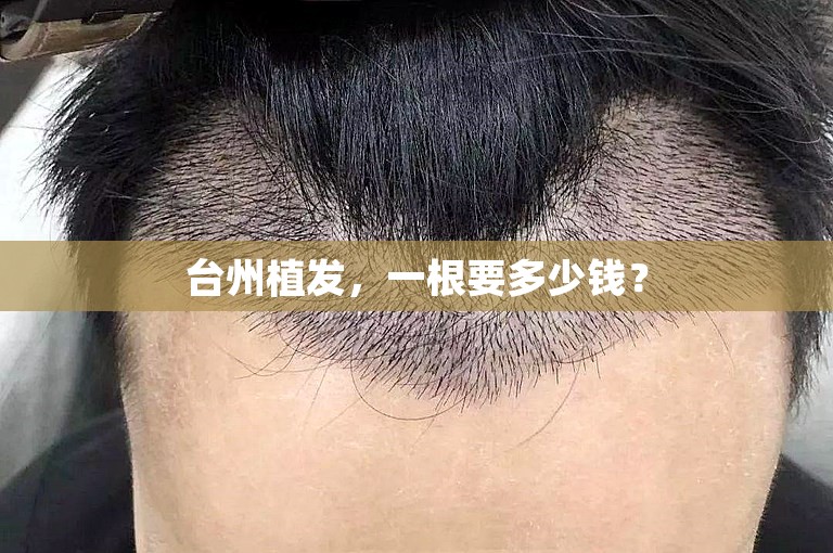 台州植发，一根要多少钱？