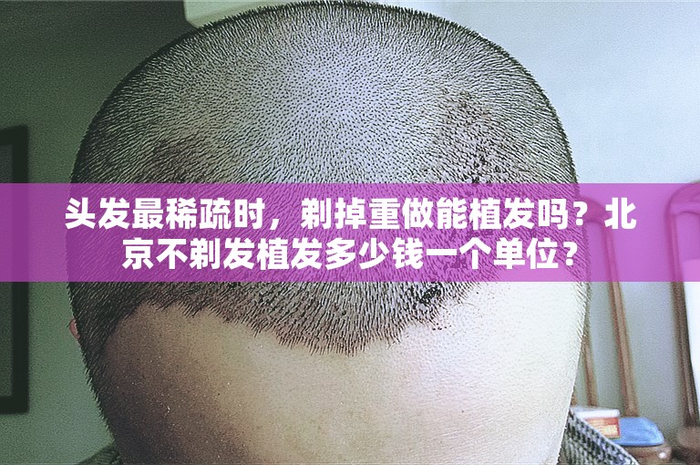 头发最稀疏时，剃掉重做能植发吗？北京不剃发植发多少钱一个单位？