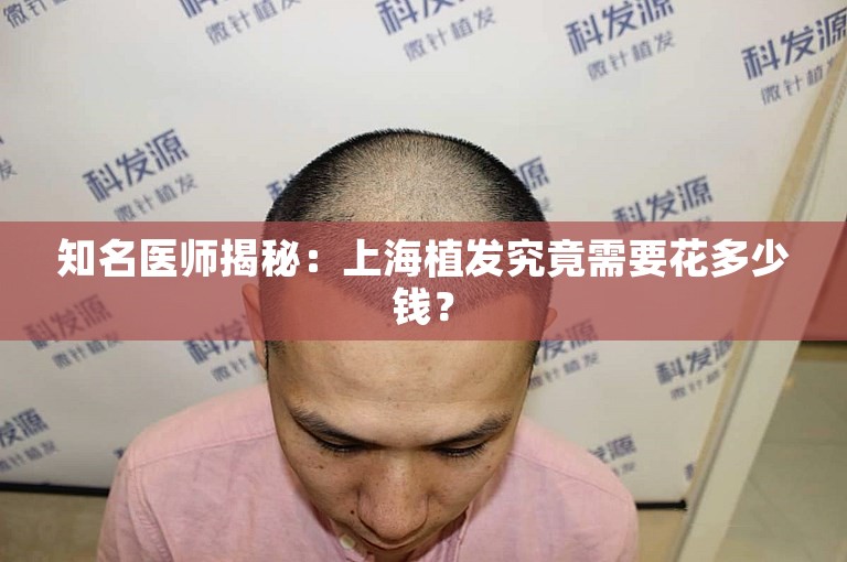 知名医师揭秘：上海植发究竟需要花多少钱？