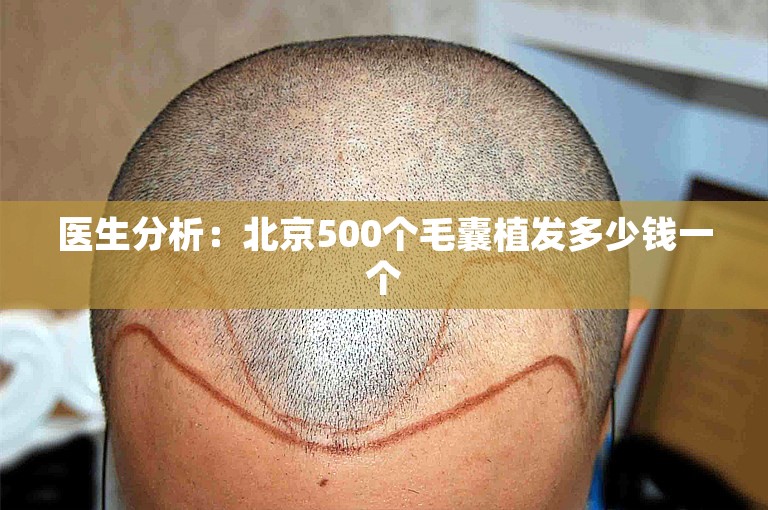 医生分析：北京500个毛囊植发多少钱一个