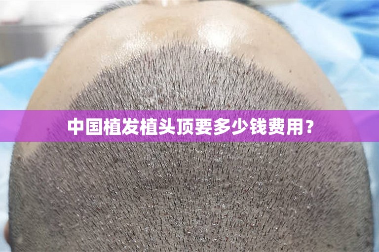 中国植发植头顶要多少钱费用？