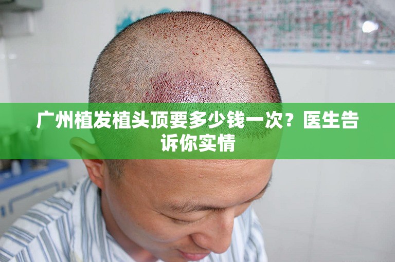 广州植发植头顶要多少钱一次？医生告诉你实情