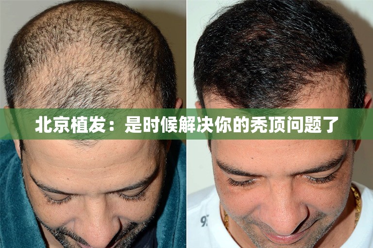 北京植发：是时候解决你的秃顶问题了