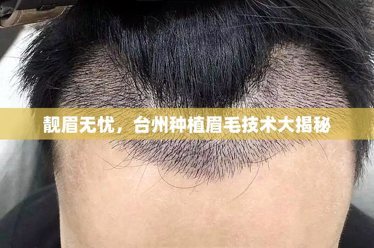 靓眉无忧，台州种植眉毛技术大揭秘