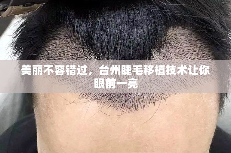 美丽不容错过，台州睫毛移植技术让你眼前一亮