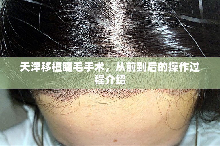 天津移植睫毛手术，从前到后的操作过程介绍