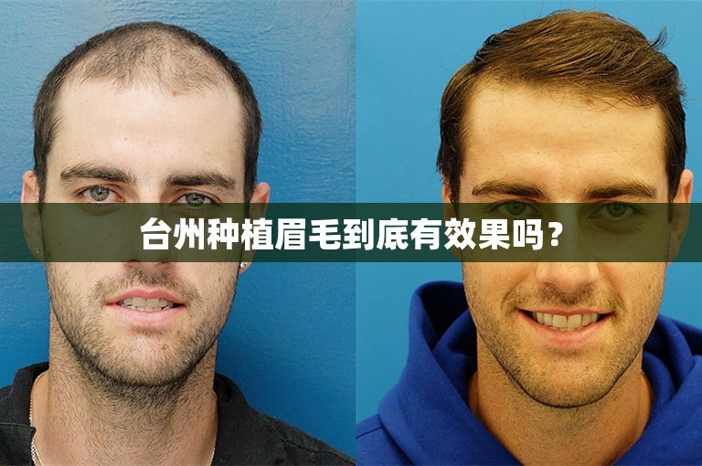 台州种植眉毛到底有效果吗？