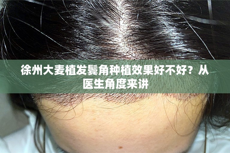 徐州大麦植发鬓角种植效果好不好？从医生角度来讲