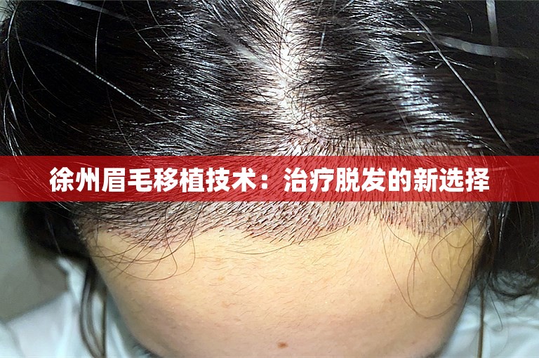 徐州眉毛移植技术：治疗脱发的新选择