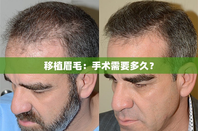 移植眉毛：手术需要多久？