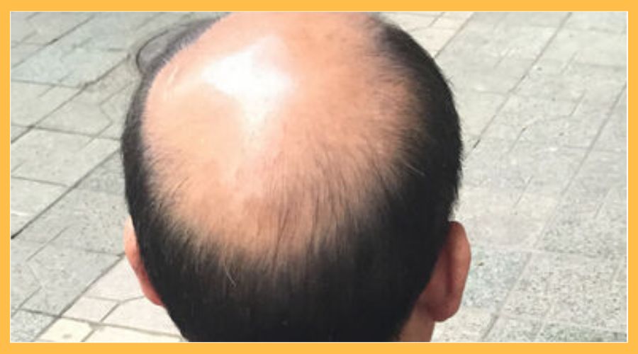 脱发后头皮变得又硬又光滑， 植发还能成活吗？