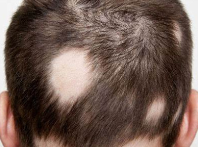 斑秃能够靠植发恢复吗
