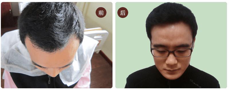上海毛发移植手术需要做几次？