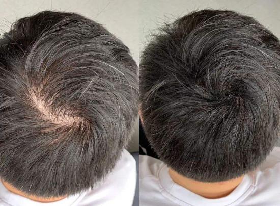 上海毛发移植手术需要做几次？