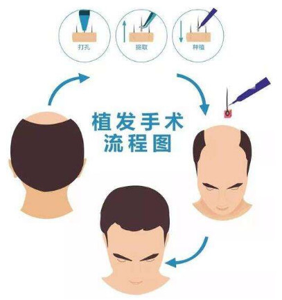 上海毛发移植的效果怎么样