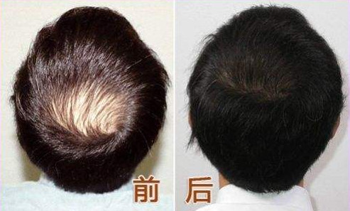 上海毛发移植的效果怎么样