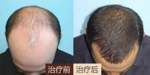 上海毛发移植手术效果好不好呢