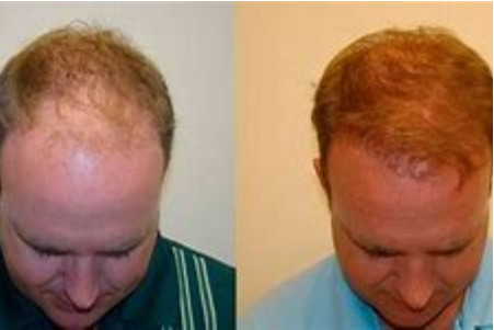 PRE修复头发移植技术怎么样