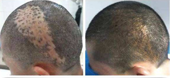 疤痕植发后需要多长时间才能生长？