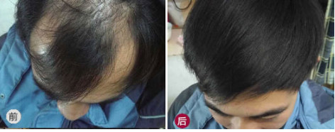 脂溢性脱发的治疗方法？不做植发手术头发能长起来吗？