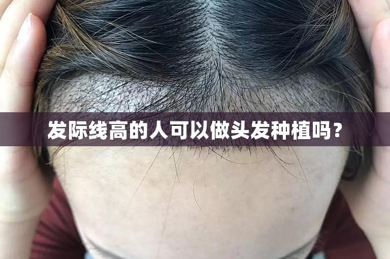 发际线高的人可以做头发种植吗？