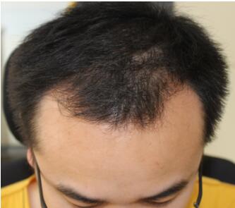 没有人想要一只秃头啊，所以我在南昌科发源做了植发