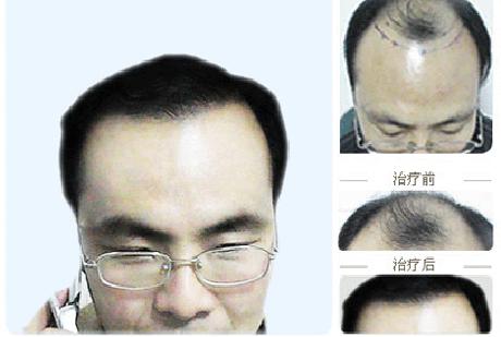 男性脱发植发的危害知识，植发的危害应该如何避免呢？