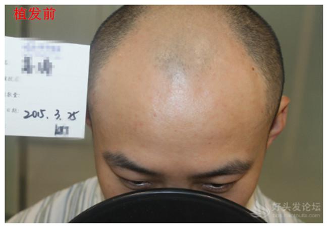 五级脱发植发效果 直击提取毛囊手术现场！
