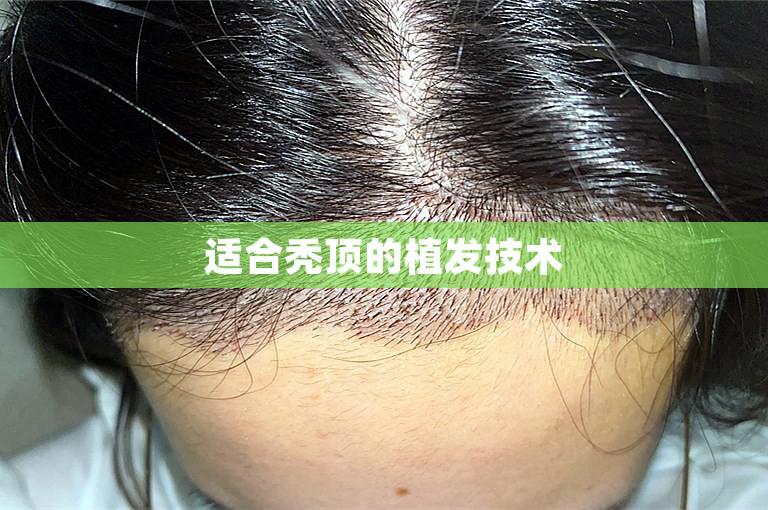 适合秃顶的植发技术