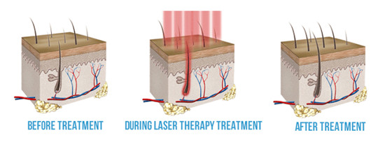 低能量激光在脱发和植发术后中的应用效果怎么样