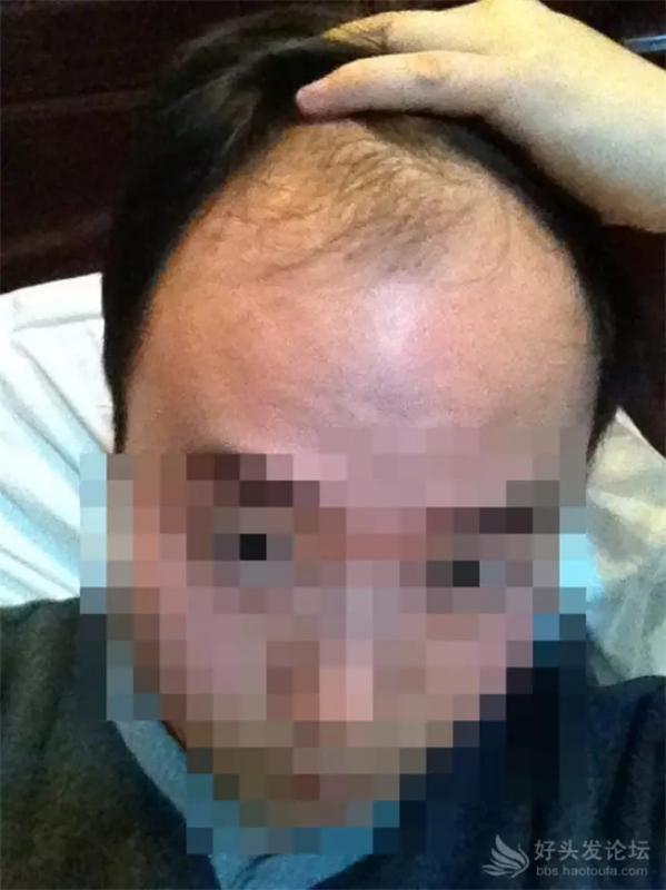 35岁严重脱发，植发7个月后这效果能接受吗？