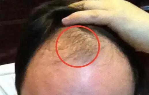 35岁严重脱发，植发7个月后这效果能接受吗？
