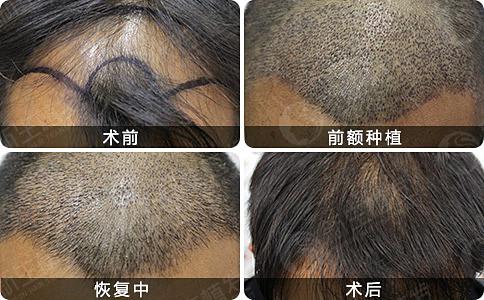 杭州植发种植头发能改善脱发症状吗？