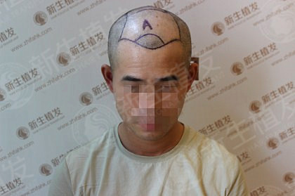 杭州新生植发医生解答：植毛发真的灵验果吗