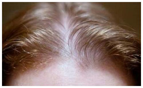种植发际线会长头发吗