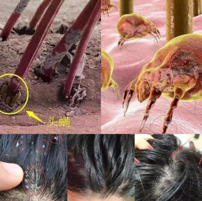 上千只螨虫在啃你的头皮，头油、瘙痒、脱发、异味…