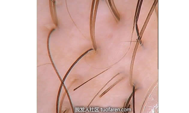M型脱发的10个早期症状及有效预防方法